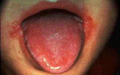 Symptomen en tekenen van stomatitis bij kinderen