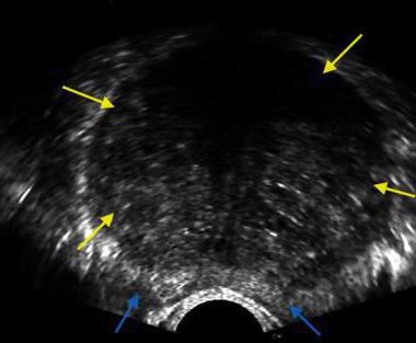Transrectale echografie van de prostaat: beschrijving, voorbereiding en aanbevelingen